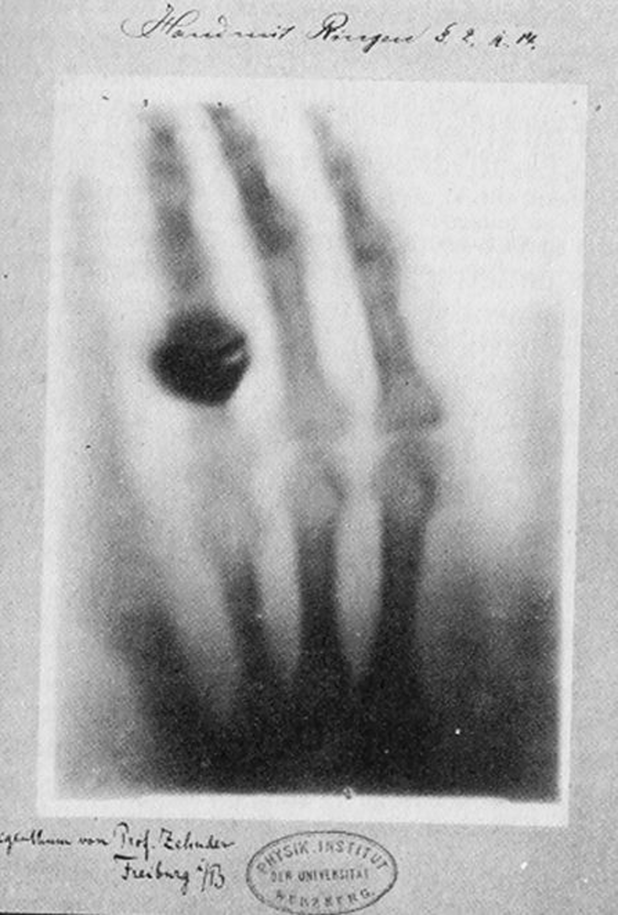 mão com anel (Röntgen)